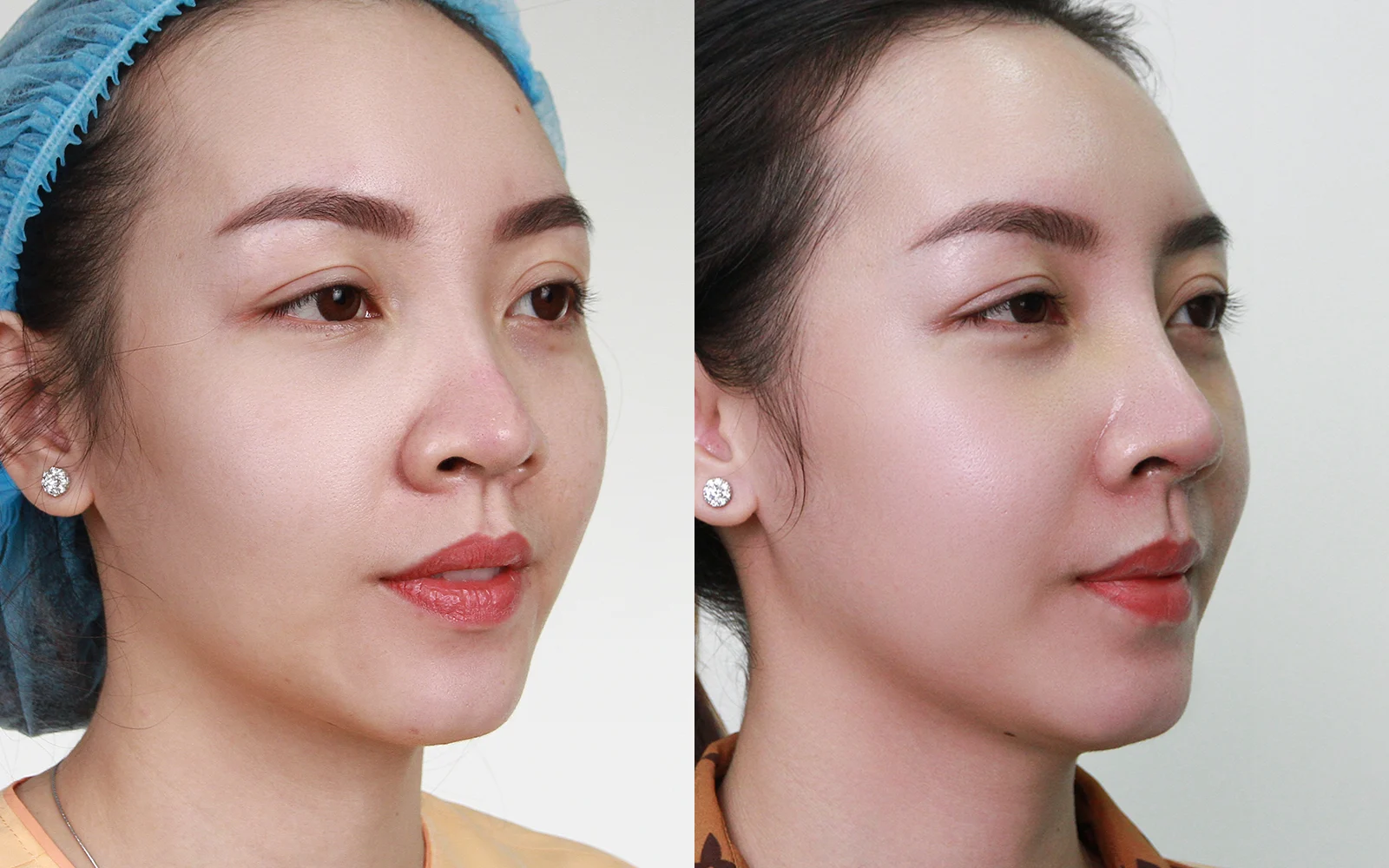 Before and after treatment silhouette